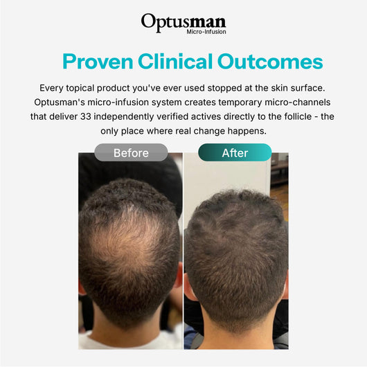 Optus™ Micro Infusion Hair Revival
